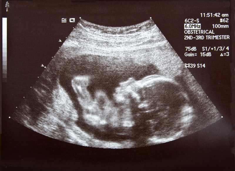Osoby, które przed 17 tygodniem ciąży chciałyby zobaczyć płód na zdjęciach 2D lub 3D, muszą skorzystać z wizyty prywatnej, co zwiąże się z opłatami.